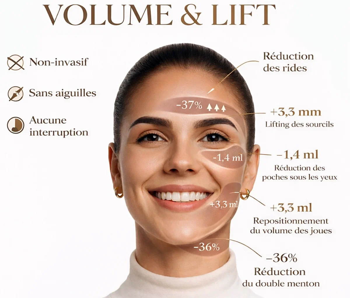 Cartographie des résultats EMFACE : −37% de rides, +3,3 mm de lifting des sourcils, −1,4 ml de poches sous les yeux, +3,3 ml de repositionnement du volume des joues, −36% de réduction du double menton.